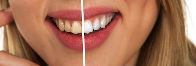 Die Zähne einer Frau vor und nach der Zahnaufhellung.