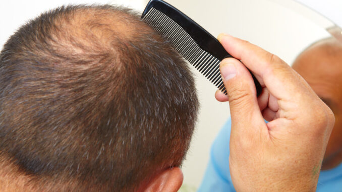 Senior man and hair loss issue